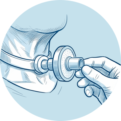 Patient mit Trachealkanüle, auf die eine Hand einen passiven HME-Filter („künstliche Nase“) aufsetzt.