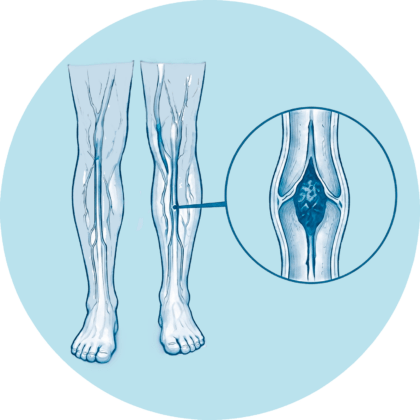 Schematische Darstellung der Beinvorgänge mit einer Lupe, die ein Blutgerinnsel (Thrombus) in einer tiefen Beinvene zeigt.