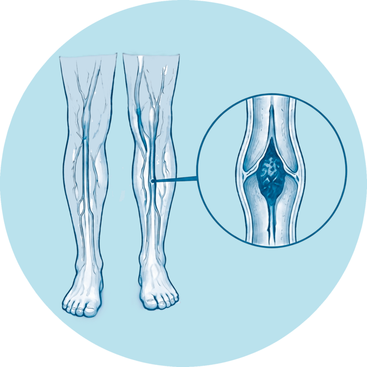 Schematische Darstellung der Beinvorgänge mit einer Lupe, die ein Blutgerinnsel (Thrombus) in einer tiefen Beinvene zeigt.
